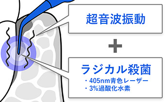 ブルーラジカル治療