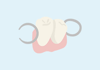部分入れ歯