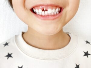 子供の過剰歯とは？│原因・見つけ方・治療の必要性をわかりやすく解説