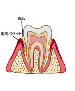 歯周ポケットとは？│プロービング検査でわかること