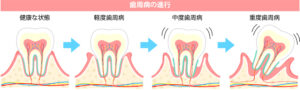 【非外科処置】ブルーラジカルP-01とは？歯周病治療の新しい選択肢